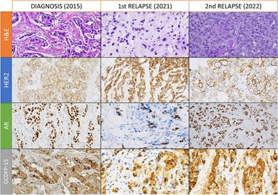 Multiomic analysis of HER2-enriched and AR-positive breast carcinoma with apocrine differentiation and an oligometastatic course: a case report